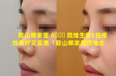 鞍山哪家医 🐟 院维生素E祛痘效果好又实惠「鞍山哪家医院维生素e祛痘效果好又实惠呢」